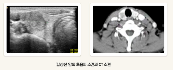 ���� ���� ������ �Ұ߰� CT �Ұ�