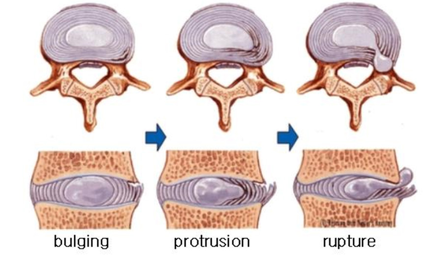 �߰��� Ż����